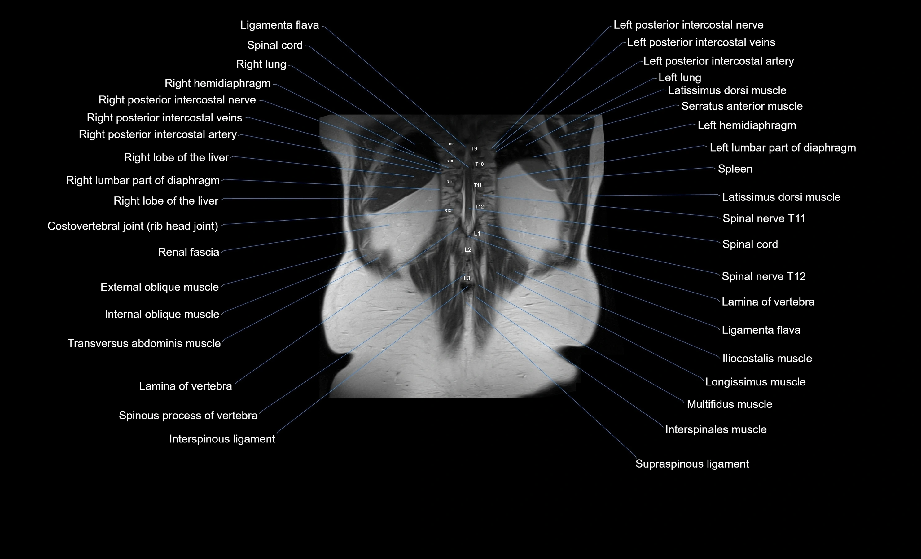 MRI Abdomen coronal labelled cross sectional anatomy radiology  image-img-00001-00050.webp